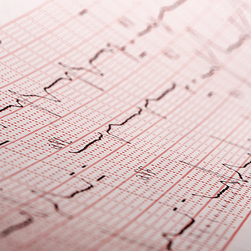 ECG